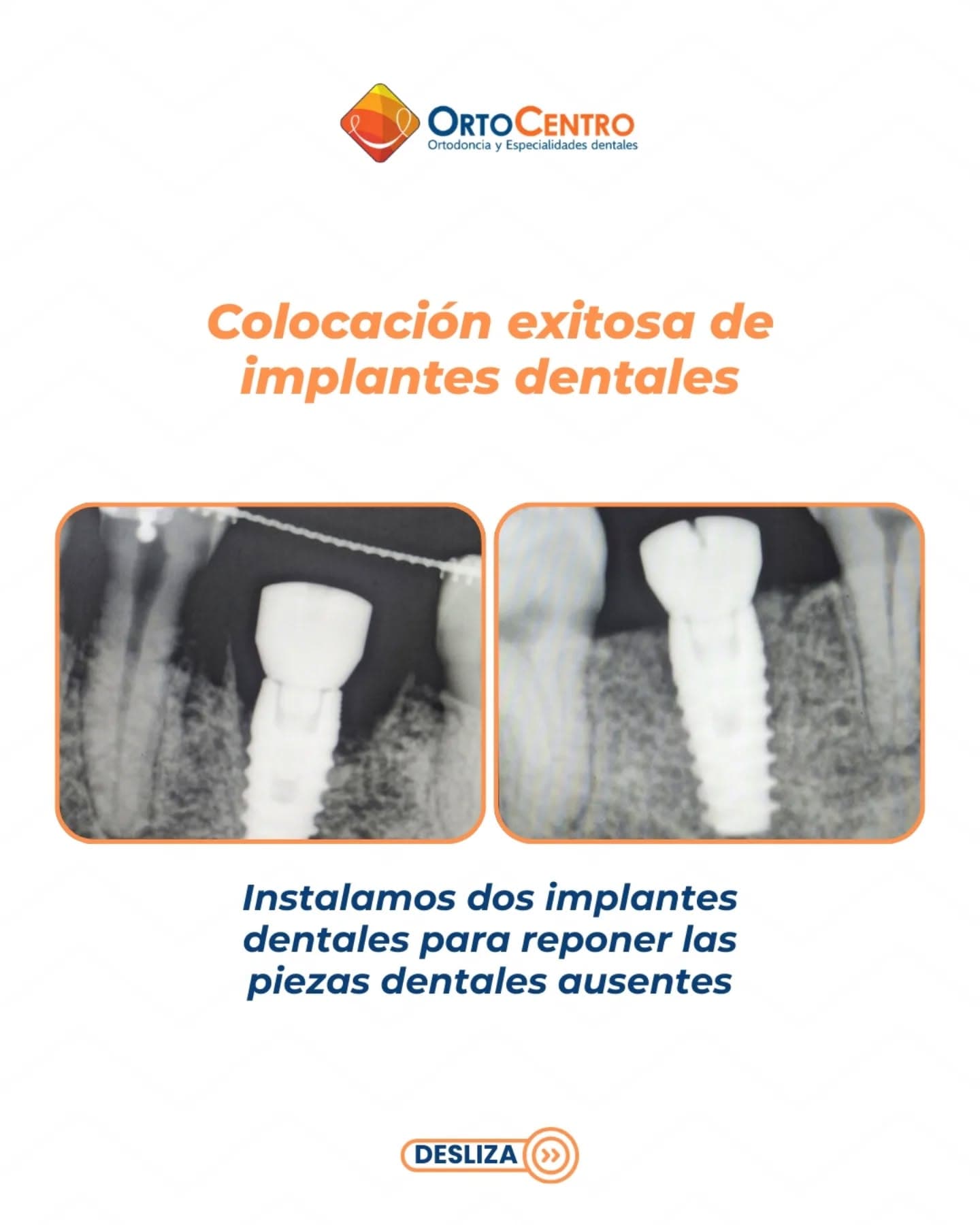 Arte real de OrtoCentro sobre implantes dentales